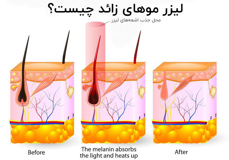 لیزر موهای زائد چیست؟